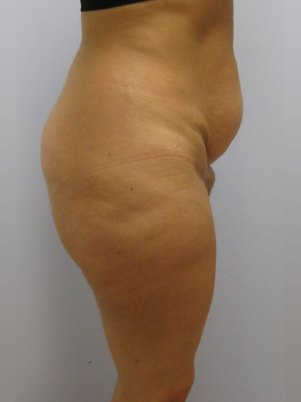 Tummy Tuck Before & After Image