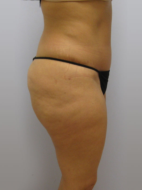 Tummy Tuck Before & After Image