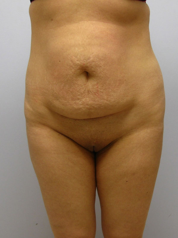 Tummy Tuck Before & After Image