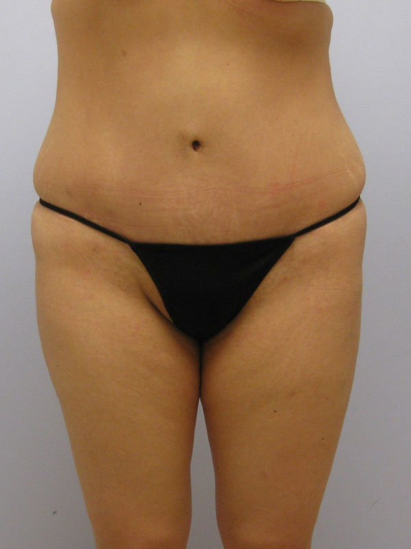 Tummy Tuck Before & After Image