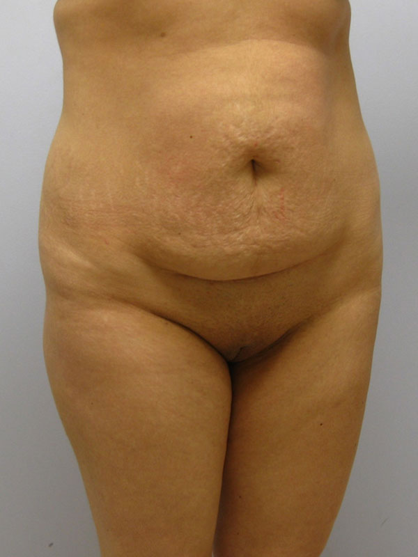 Tummy Tuck Before & After Image