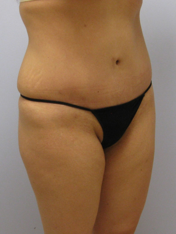 Tummy Tuck Before & After Image