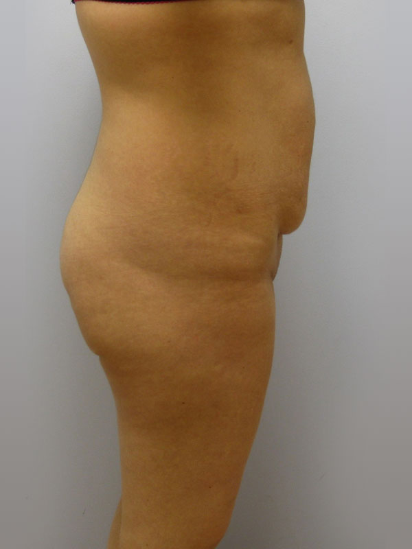 Tummy Tuck Before & After Image