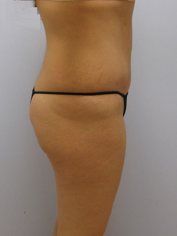 Tummy Tuck Before & After Image