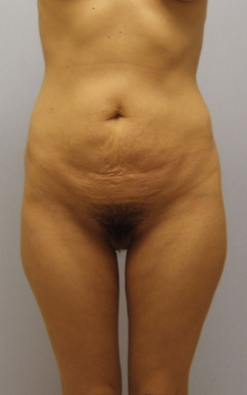 Tummy Tuck Before & After Image