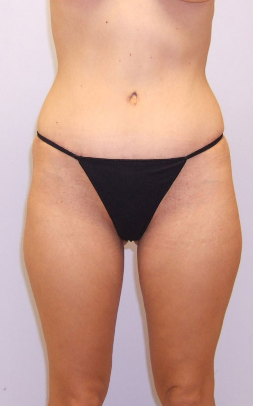 Tummy Tuck Before & After Image