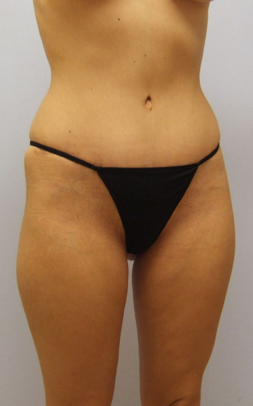 Tummy Tuck Before & After Image