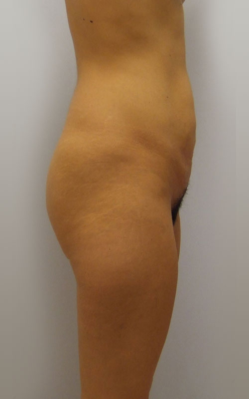 Tummy Tuck Before & After Image