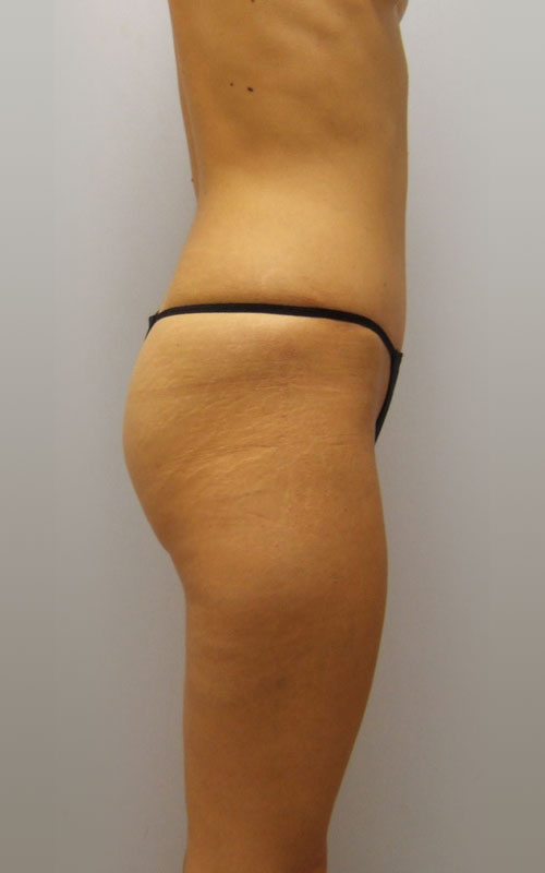 Tummy Tuck Before & After Image