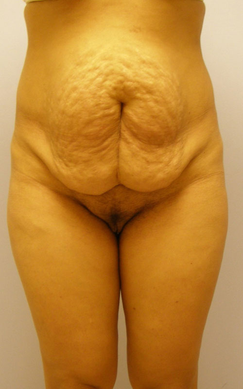 Tummy Tuck Before & After Image