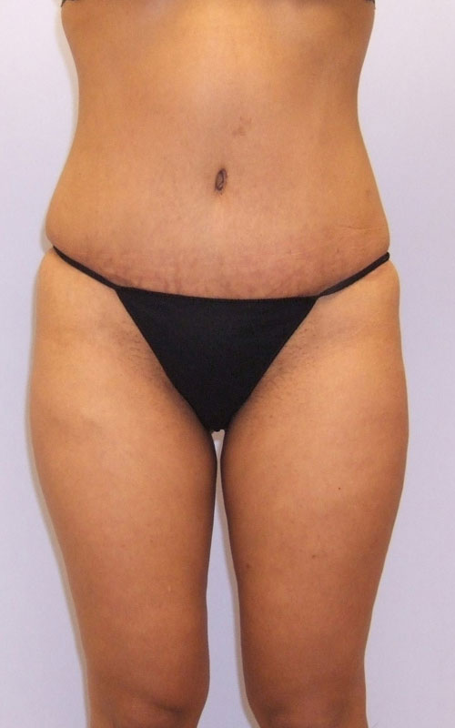 Tummy Tuck Before & After Image