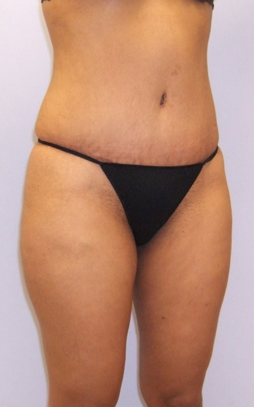 Tummy Tuck Before & After Image