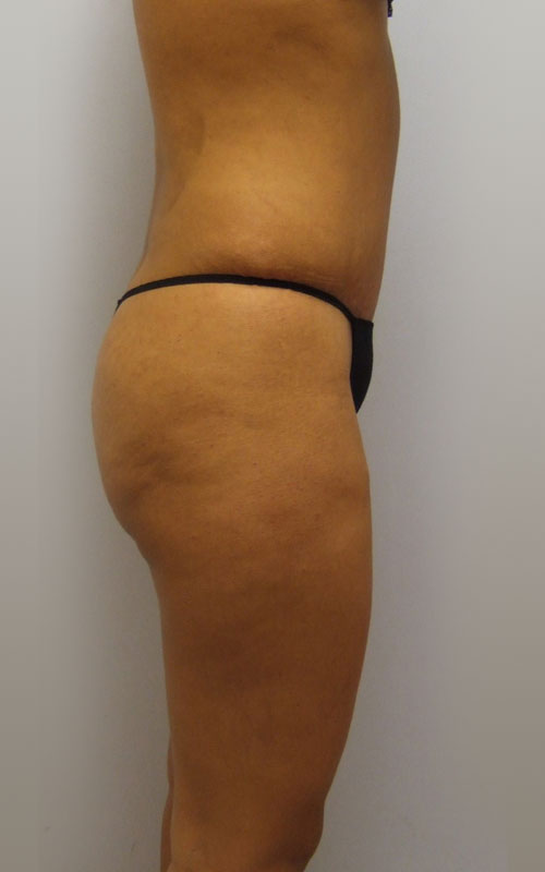 Tummy Tuck Before & After Image