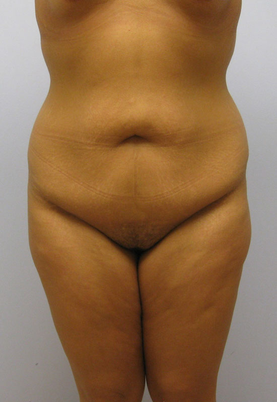 Tummy Tuck Before & After Image