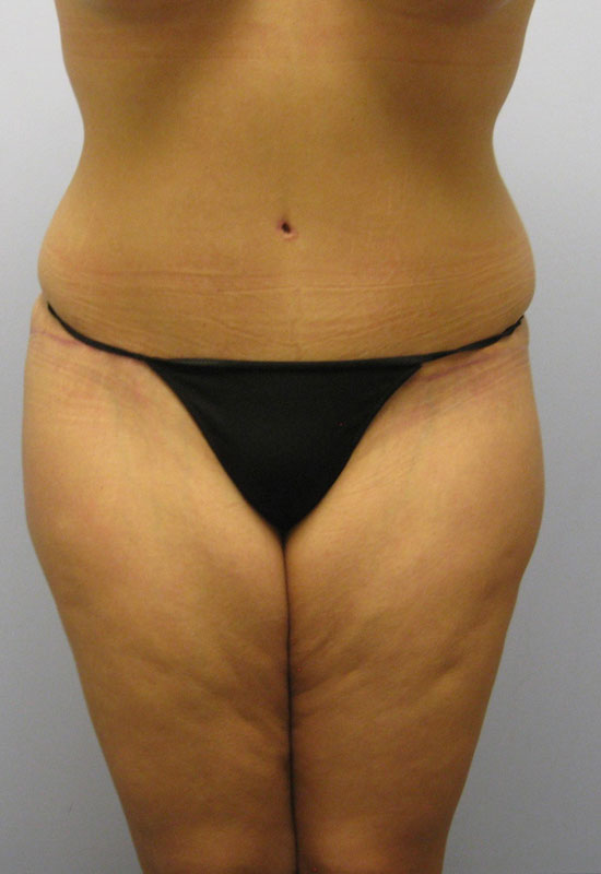 Tummy Tuck Before & After Image