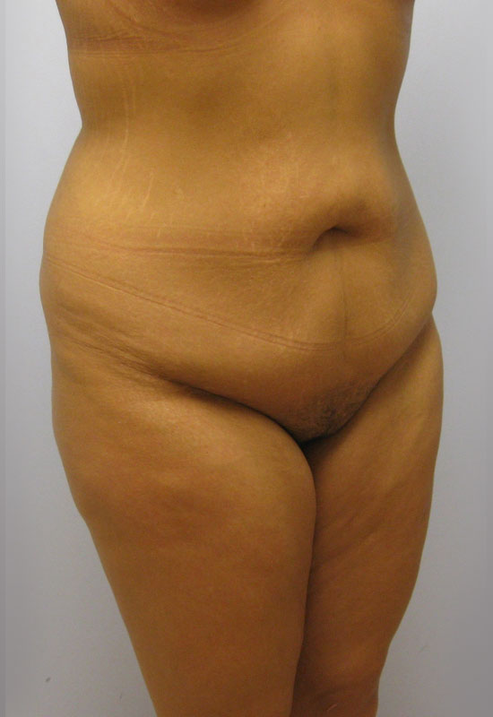 Tummy Tuck Before & After Image