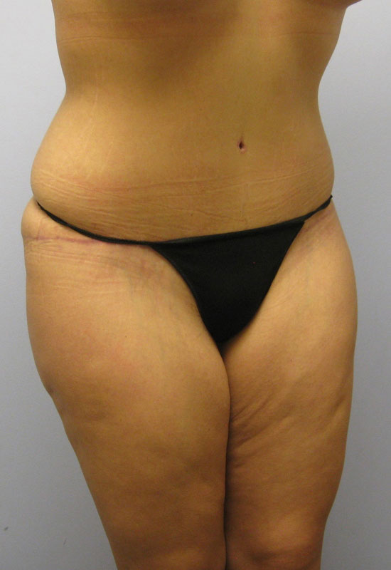 Tummy Tuck Before & After Image