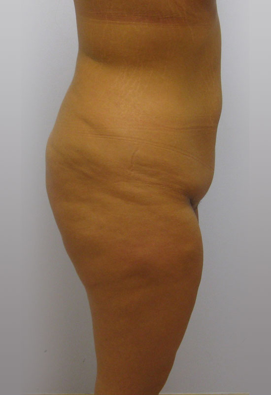 Tummy Tuck Before & After Image