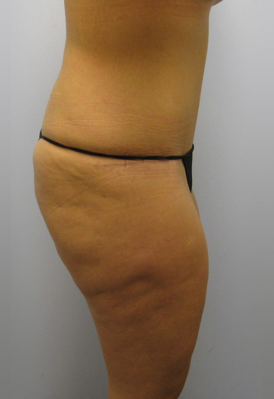 Tummy Tuck Before & After Image