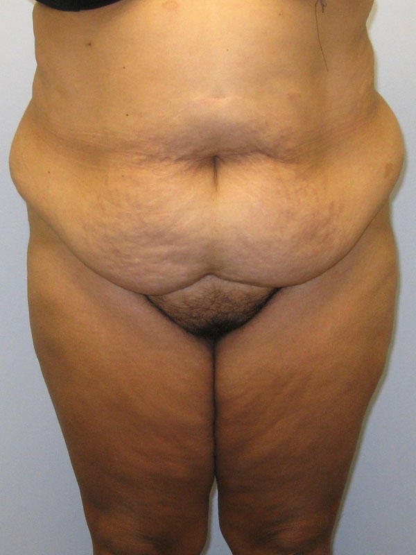 Tummy Tuck Before & After Image