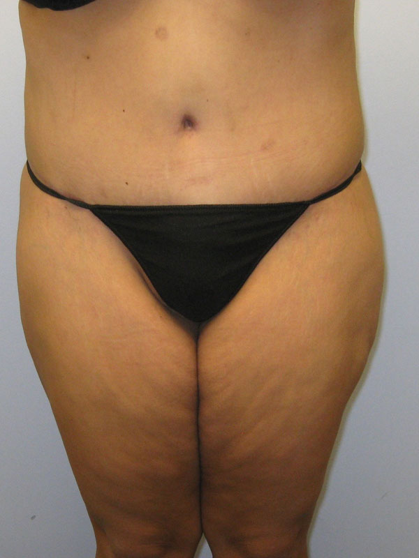 Tummy Tuck Before & After Image