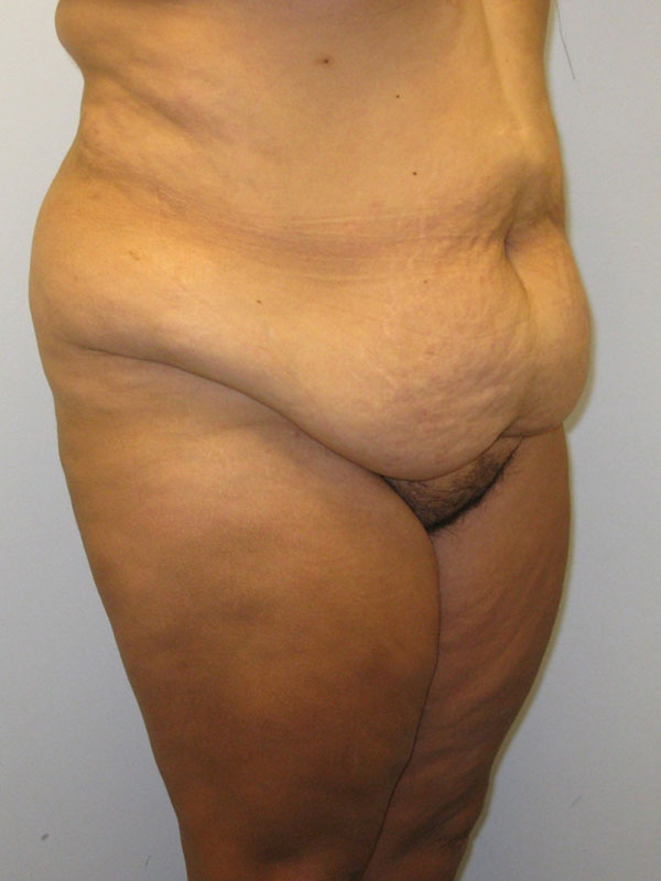 Tummy Tuck Before & After Image