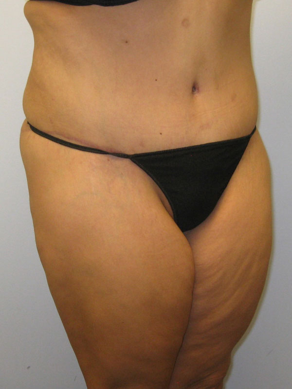 Tummy Tuck Before & After Image