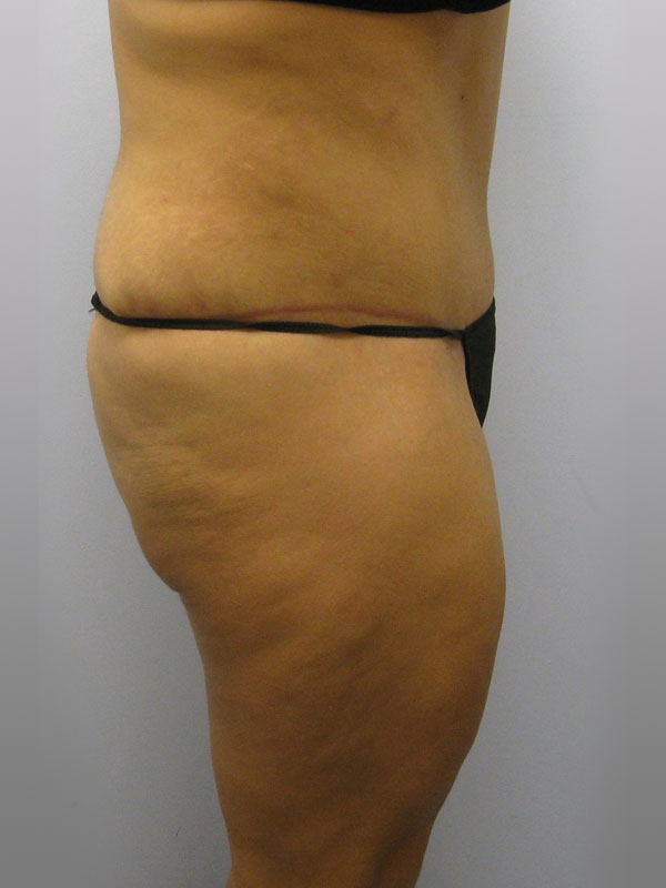 Tummy Tuck Before & After Image