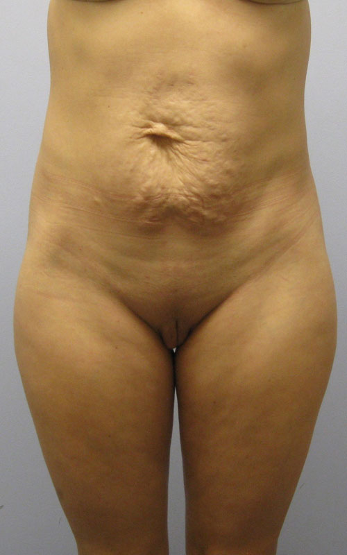 Tummy Tuck Before & After Image