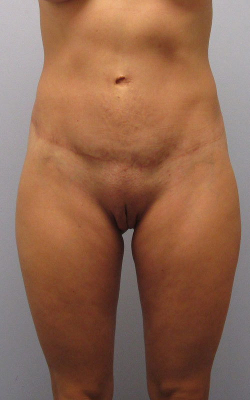 Tummy Tuck Before & After Image