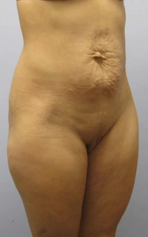 Tummy Tuck Before & After Image