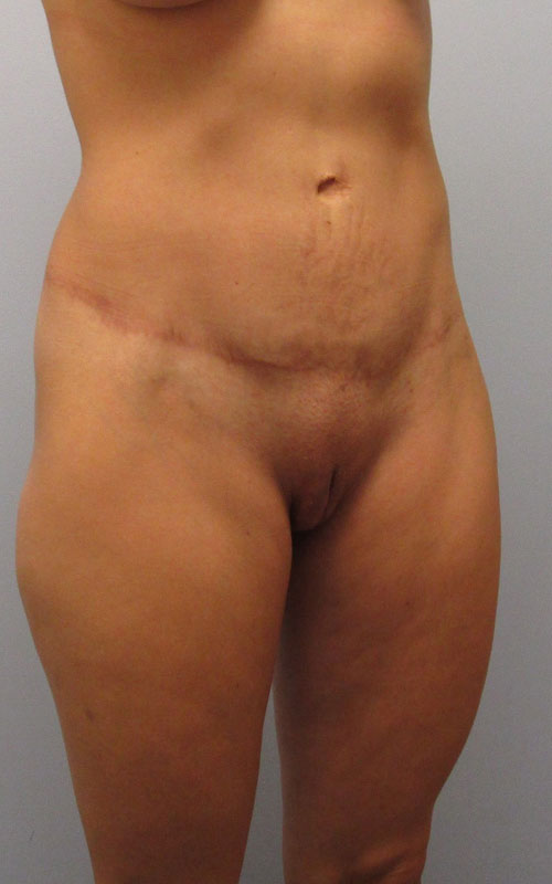 Tummy Tuck Before & After Image