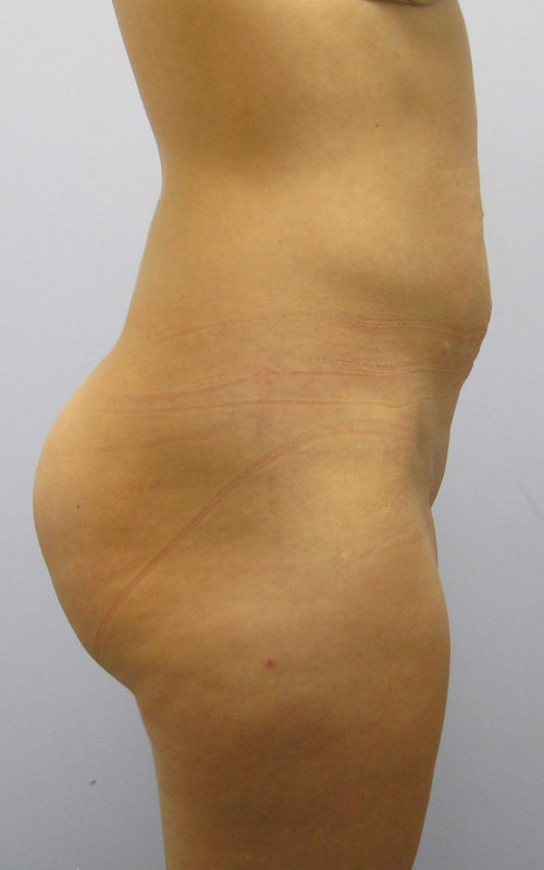 Tummy Tuck Before & After Image