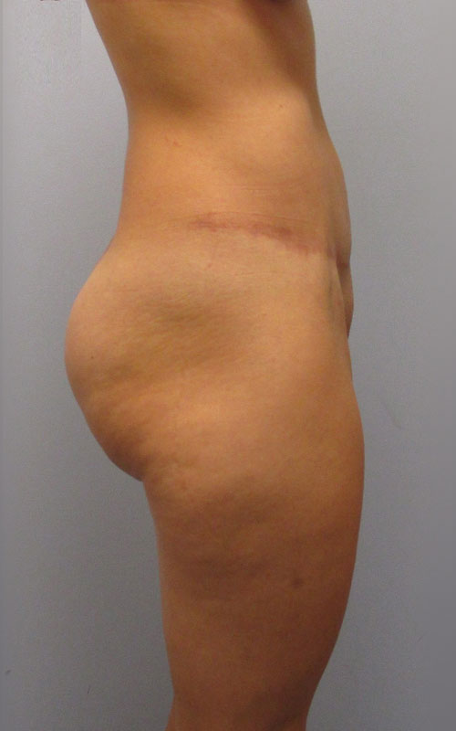 Tummy Tuck Before & After Image