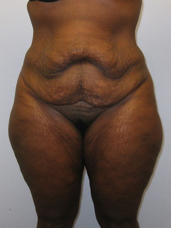 Tummy Tuck Before & After Image