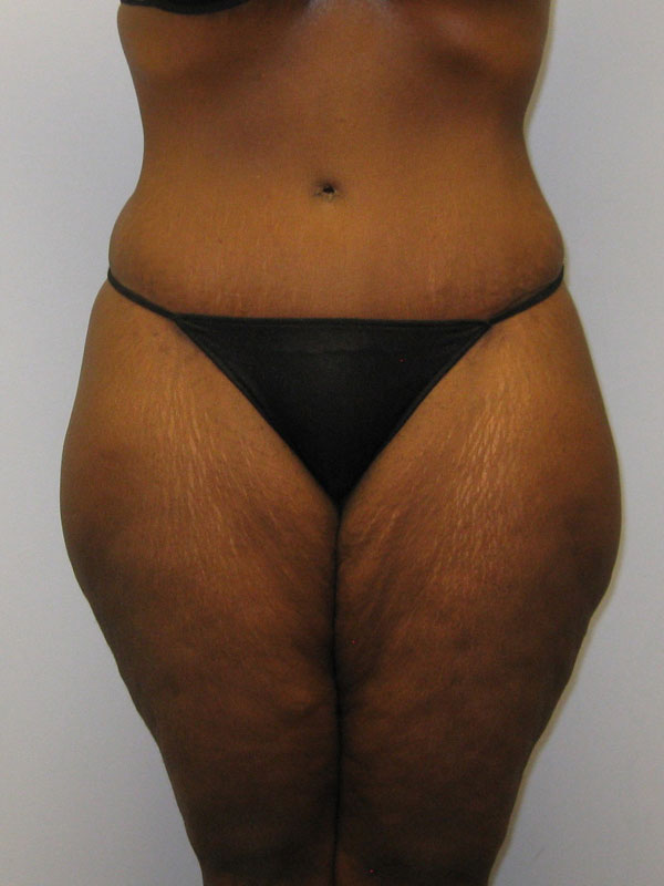 Tummy Tuck Before & After Image