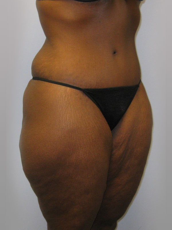 Tummy Tuck Before & After Image