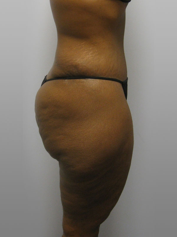 Tummy Tuck Before & After Image