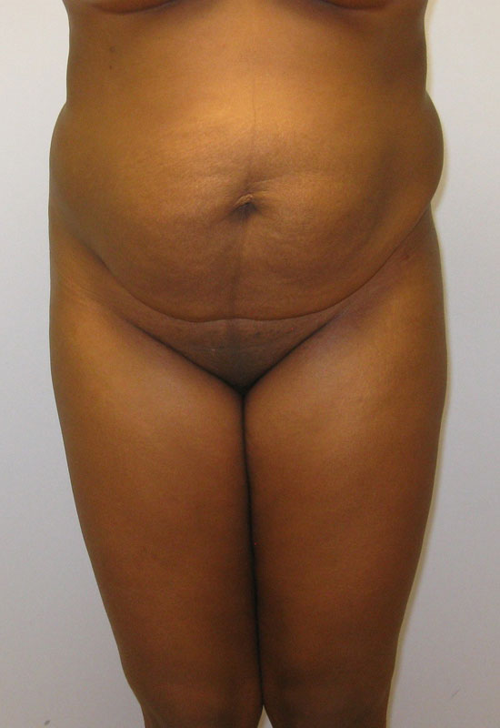 Tummy Tuck Before & After Image