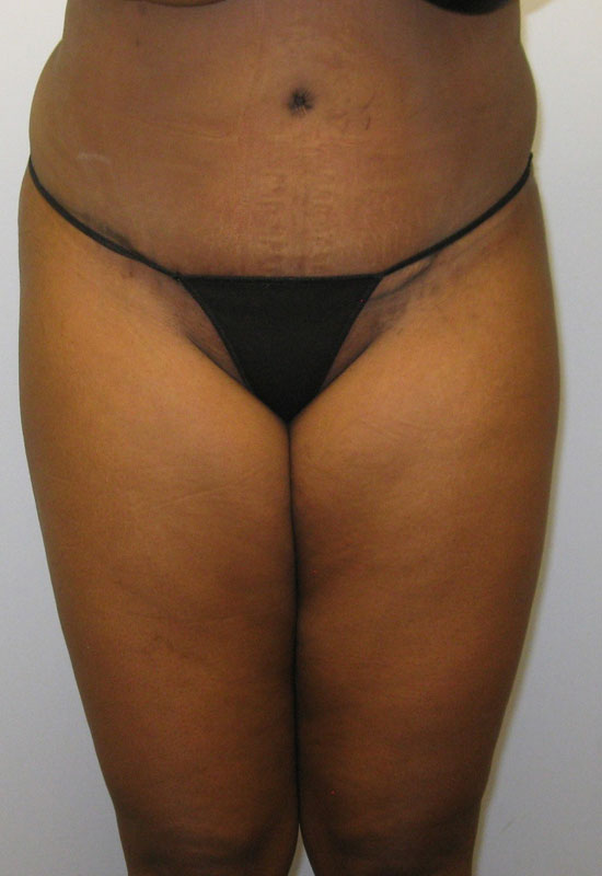 Tummy Tuck Before & After Image