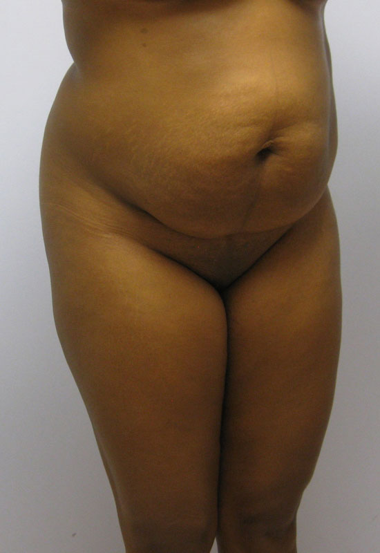 Tummy Tuck Before & After Image