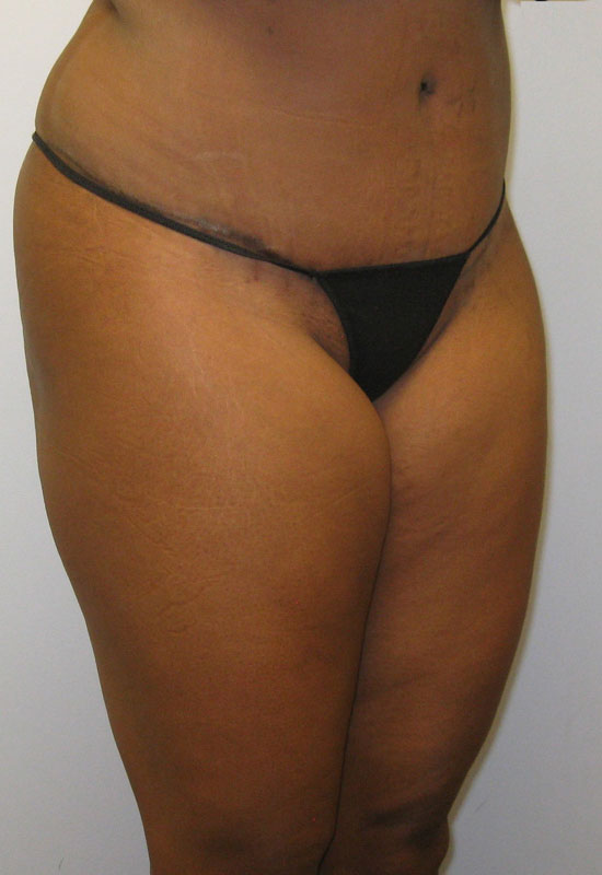 Tummy Tuck Before & After Image