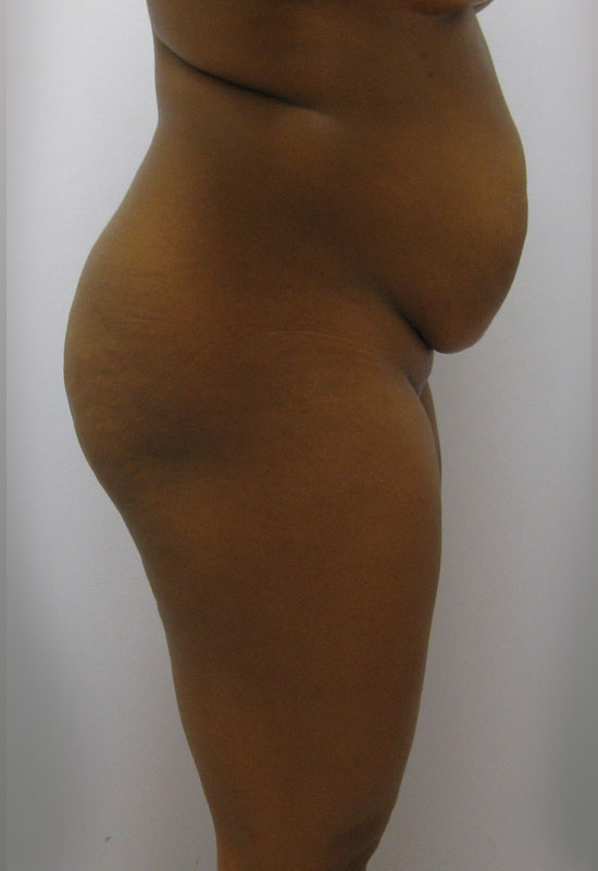 Tummy Tuck Before & After Image