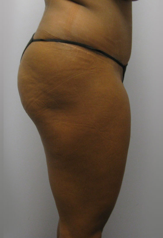 Tummy Tuck Before & After Image