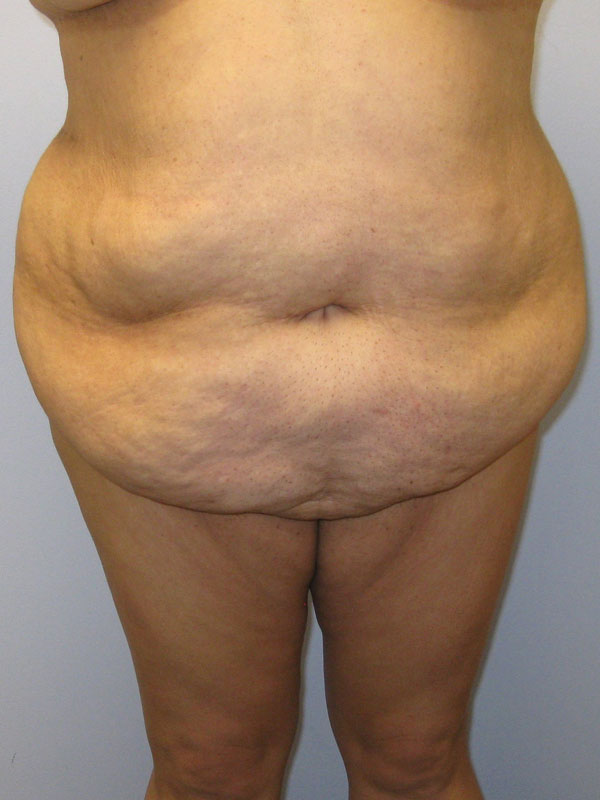 Tummy Tuck Before & After Image