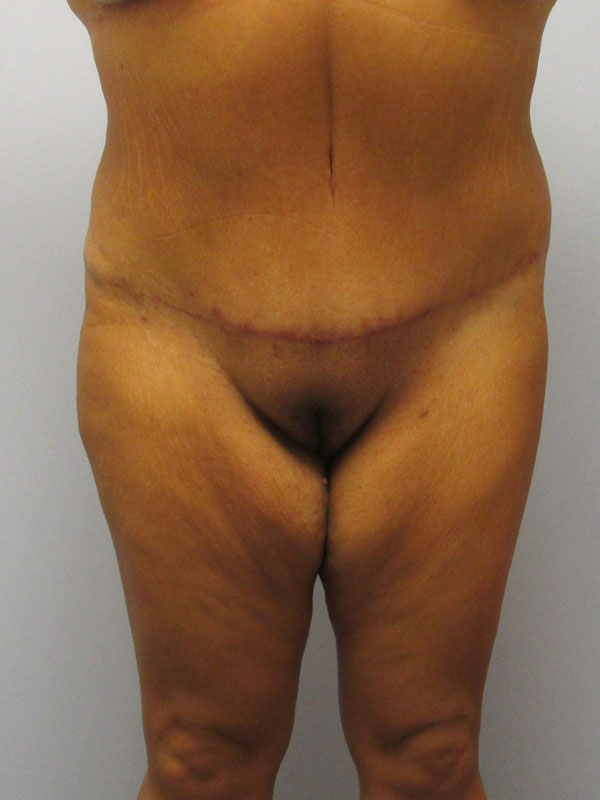 Tummy Tuck Before & After Image