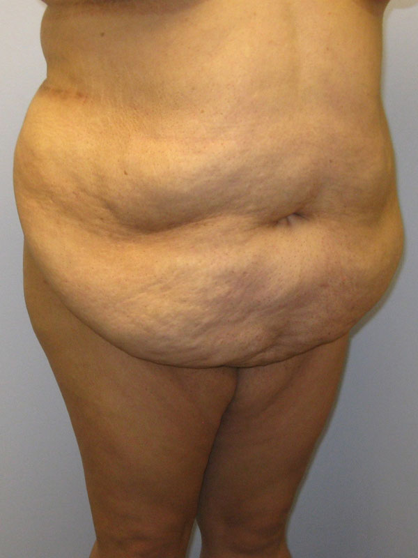 Tummy Tuck Before & After Image