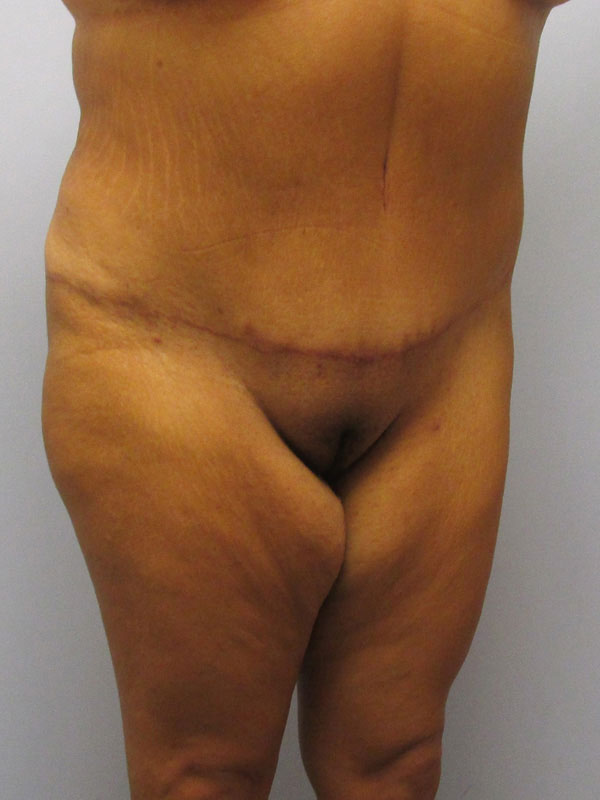 Tummy Tuck Before & After Image