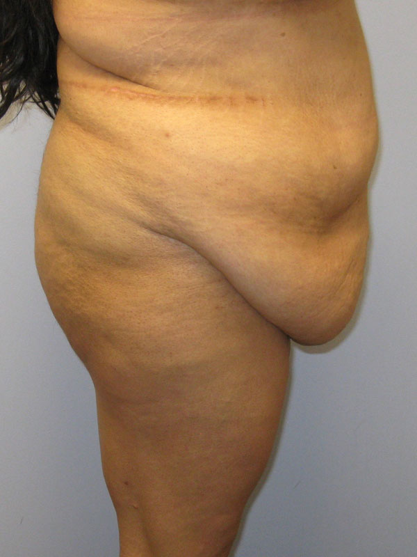 Tummy Tuck Before & After Image