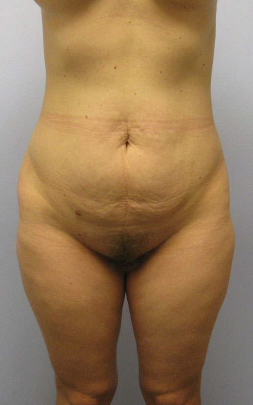 Tummy Tuck Before & After Image